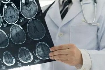 وضعیت بروز سکته مغزی در ایران