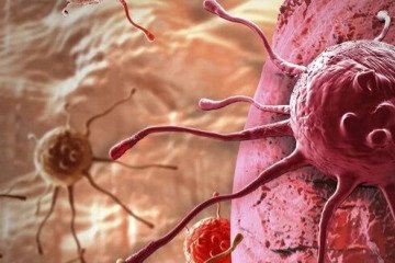 پیشگیری ۳۰ تا ۵۰ درصدی سرطان‌ها با غربالگری