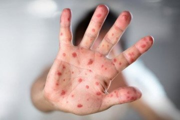 احتمال ابتلا به آبله مرغان در فصل بهار افزایش می‌یابد