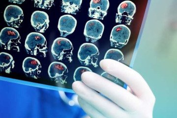سکته مغزی فقط مختص سالمندان نیست