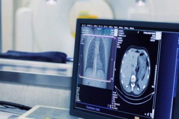 سی‌تی‌اسکن خطر ابتلا به سرطان را افزایش می‌دهد