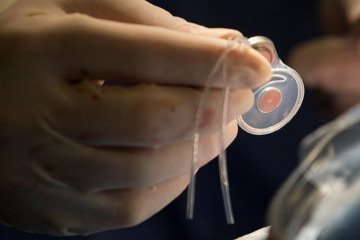 کاشت رایگان حلزون شنوایی در مراکز دولتی و برخی مراکز خصوصی