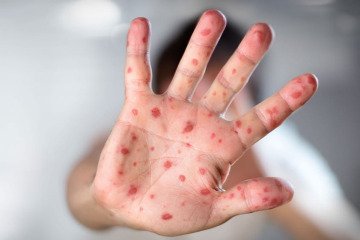 موارد ابتلا به سرخک در آمریکا به حدود ۹۰۰ تن رسید