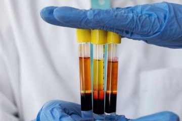 در خصوص تامین پلاسما کمبود داریم