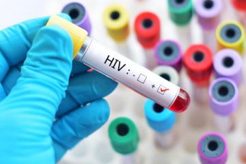 آلوده شدن صدها نوزاد و کودک به ویروس نقص ایمنی انسانی یا HIV