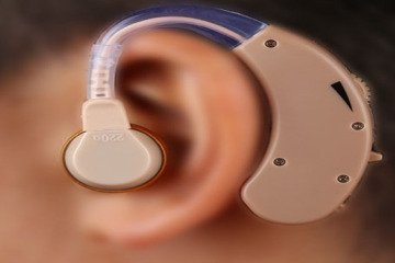 تامین رایگان پروتز حلزون شنوایی در سال گذشته برای هزار و ۴۰۱ بیمار ناشنوا