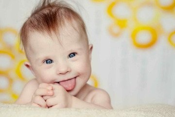 مبتلایان سندرم داون در معرض خطر بیشتر سکته مغزی و حمله قلبی