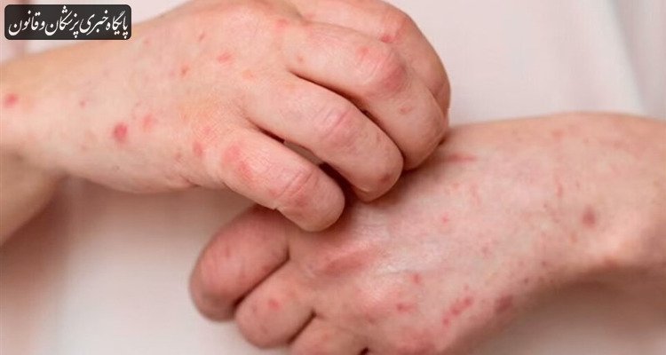 ابتلای بزرگسالان به بیماری آبلهمرغان با عوارض خطرناکتری همراه است ابتلای بزرگسالان به بیماری آبلهمرغان با عوارض خطرناکتری همراه است