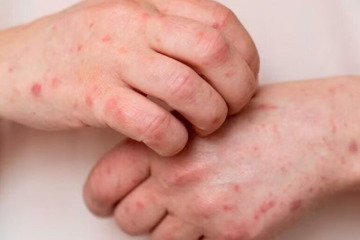 ابتلای بزرگسالان به بیماری آبله‌مرغان با عوارض خطرناک‌تری همراه است