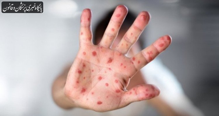این دو شهر بیشترین مبتلایان سرخک را داشتند