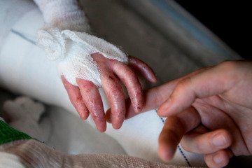 برق یک نیاز حیاتی برای کودکان مبتلا به بیماری پروانه‌ای است