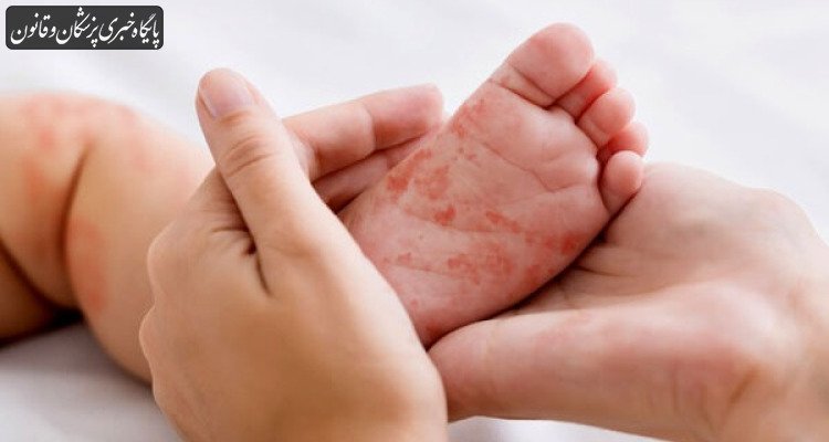 افزایش موارد ابتلای کودکان زیر ۹ ماه به سرخک