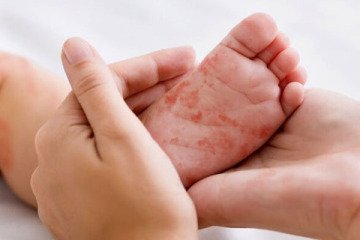 افزایش موارد ابتلای کودکان زیر ۹ ماه به سرخک