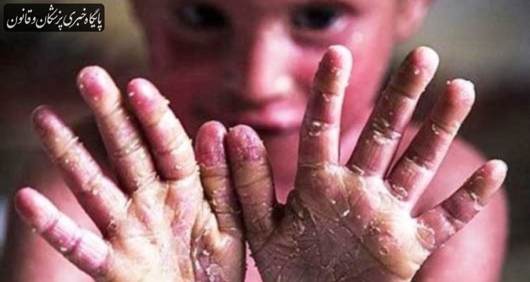 درحال حاضر هیچ مشکلی در زمینه پانسمان بیماران EB نداریم درحال حاضر هیچ مشکلی در زمینه پانسمان بیماران EB نداریم