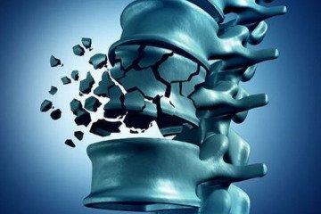 ۸۰ درصد افراد دچار مشکلات استخوانی هستند