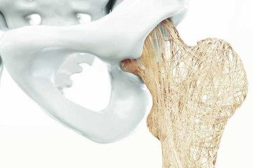 پوکی استخوان، بیماری دردناک خاموش