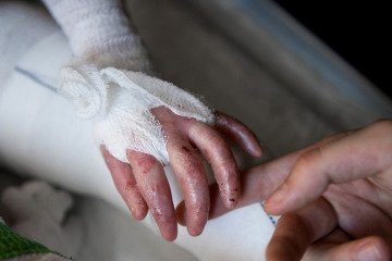 مهم‌ترین نیاز بیماران ای‌بی استفاده از پانسمان‌های تخصصی است