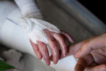 ۹۵ درصد بیماران «ای بی» حاصل ازدواج فامیلی است