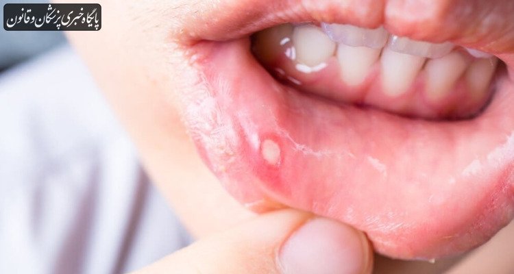 زخم‌های کوچک، خطرهای بزرگ، سرطان دهان را جدی بگیرید