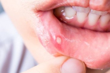 زخم‌های کوچک، خطرهای بزرگ، سرطان دهان را جدی بگیرید