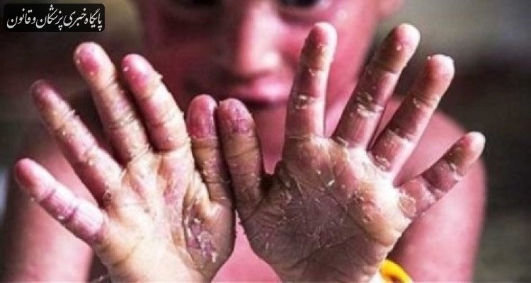 ۱۰۰ خانواده در ایران حداقل ۲ فرزند مبتلا به ای‌بی دارند