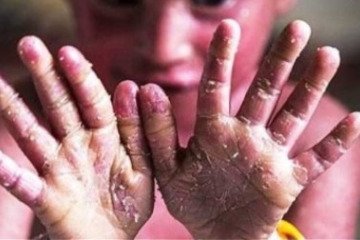 ۱۰۰ خانواده در ایران حداقل ۲ فرزند مبتلا به ای‌بی دارند