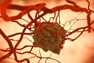 افزایش ۲ برابری مرگ‌های سرطانی در ایران تا ۲۰۴۰