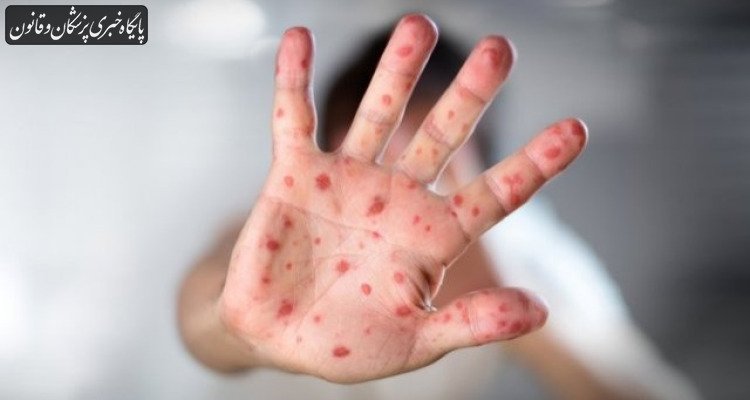 کانادا وضعیت «عاری از سرخک» خود را از دست داد