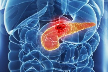 شناسایی علامت هشدار دهنده اولیه سرطان معروف به «قاتل خاموش»