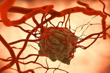 چگونه سرطان باعث مرگ می‌شود؟