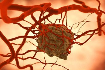 ۵۰ درصد مردم حتی نمی‌توانند یک علامت سرطان را نام ببرند