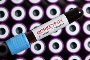 شناسایی سویه جدید «ام پاکس» در انگلیس