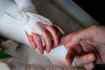 ۵ شکایت رسمی بیماران پروانه‌ای از بنیاد بیماری‌های خاص