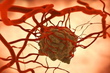 سرطان‌های معده و روده بزرگ شایع‌ترین سرطان‌ها در کشورند