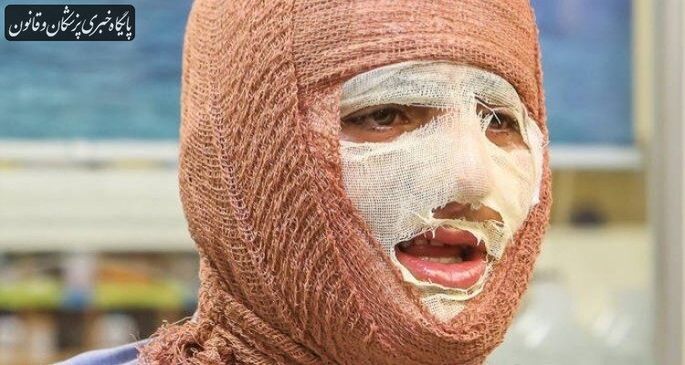 بروز سوختگی در ایران ۸ برابر میانگین جهانی است