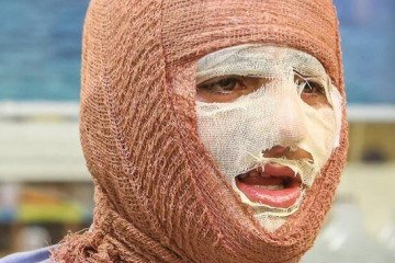 بروز سوختگی در ایران ۸ برابر میانگین جهانی است