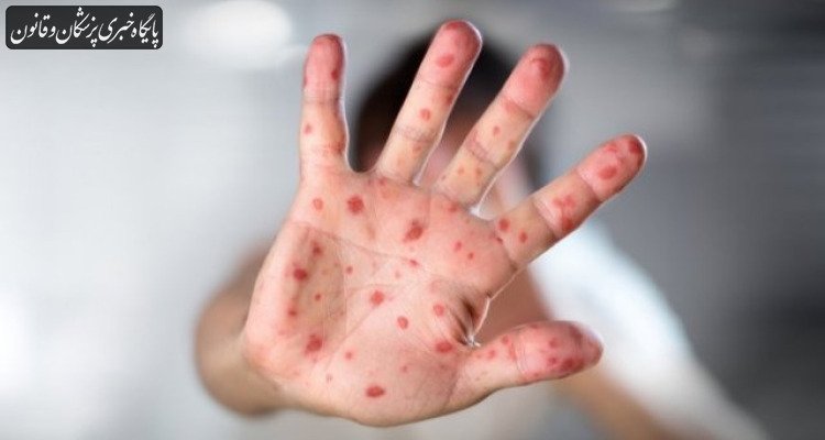 افزایش نگران‌کننده آمار سرخک در استرالیا