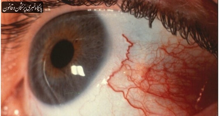 عفونت انگلی «آکانتامبا»؛ خطر تشخیص اشتباه و از دست رفتن دائم بینایی