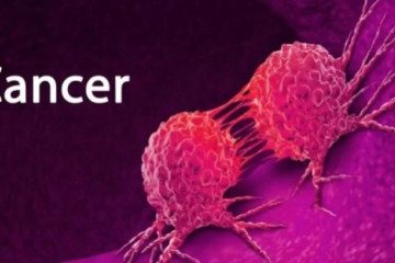 ۳۰ تا ۵۰ درصد سرطان‌ها قابل پیشگیری است