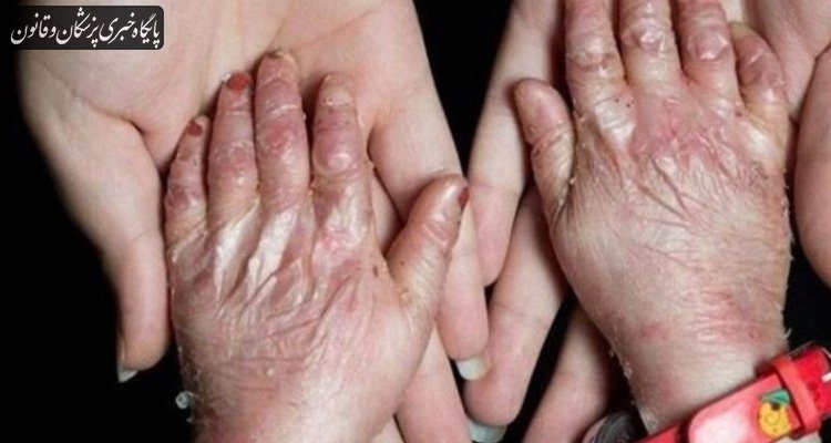 شناسایی ۴۹۲ گونه بیماری نادر در ایران