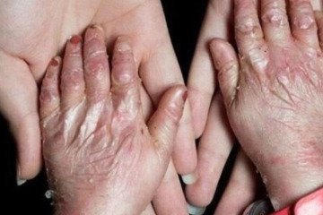 شناسایی ۴۹۲ گونه بیماری نادر در ایران