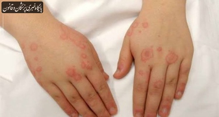 لوپوس، بیماری هزار چهره سیستم ایمنی را بشناسید