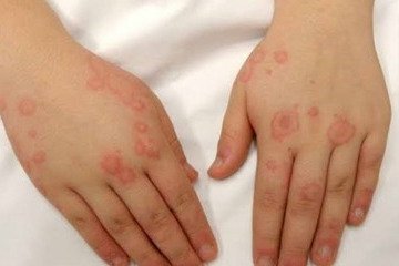 لوپوس، بیماری هزار چهره سیستم ایمنی را بشناسید
