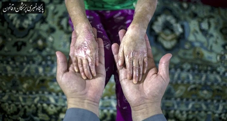 رنج بیماران پروانه‌ای جنوب کشور در شرایط قطعی برق