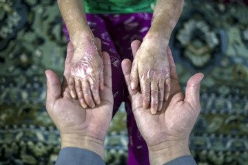رنج بیماران پروانه‌ای جنوب کشور در شرایط قطعی برق