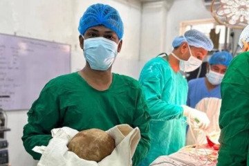 رکوردزنی پزشکان سریلانکایی با خارج کردن سنگ مثانه‌ هم‌وزن یک نوزاد از بدن بیمار
