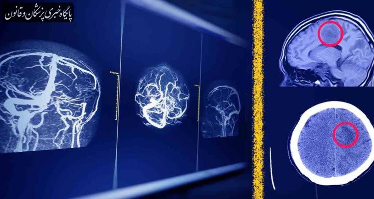 راه‌حل جدید پژوهشگران ایرانی برای افزایش امنیت هوش مصنوعی در تحلیل MRI مغز