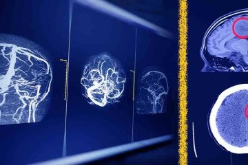 راه‌حل جدید پژوهشگران ایرانی برای افزایش امنیت هوش مصنوعی در تحلیل MRI مغز