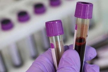 شناسایی خطر بیماری‌های کاردیومتابولیک در کودکان با آزمایش خون