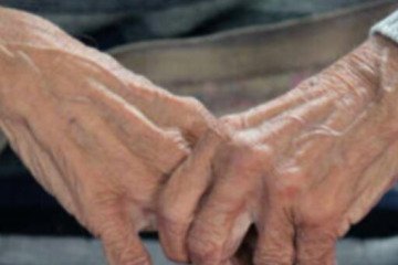 تغییر الگوی ابتلا به آلزایمر پس از کرونا